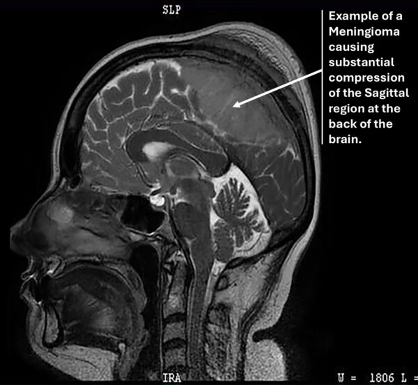 CT Image showing an example of a meningioma causing substantial compression of the sagittal region of the brain